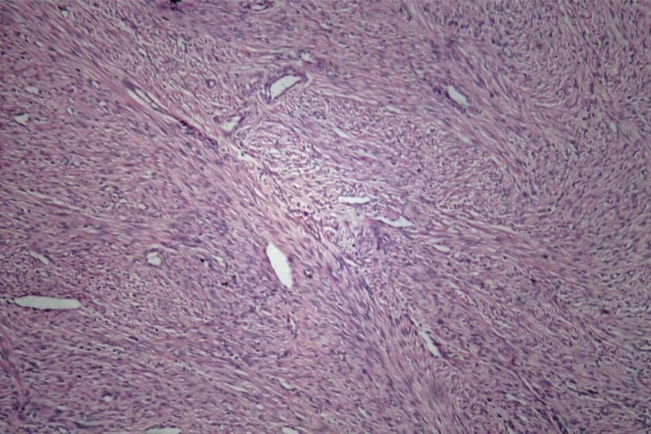 Bacteria shown in pap test