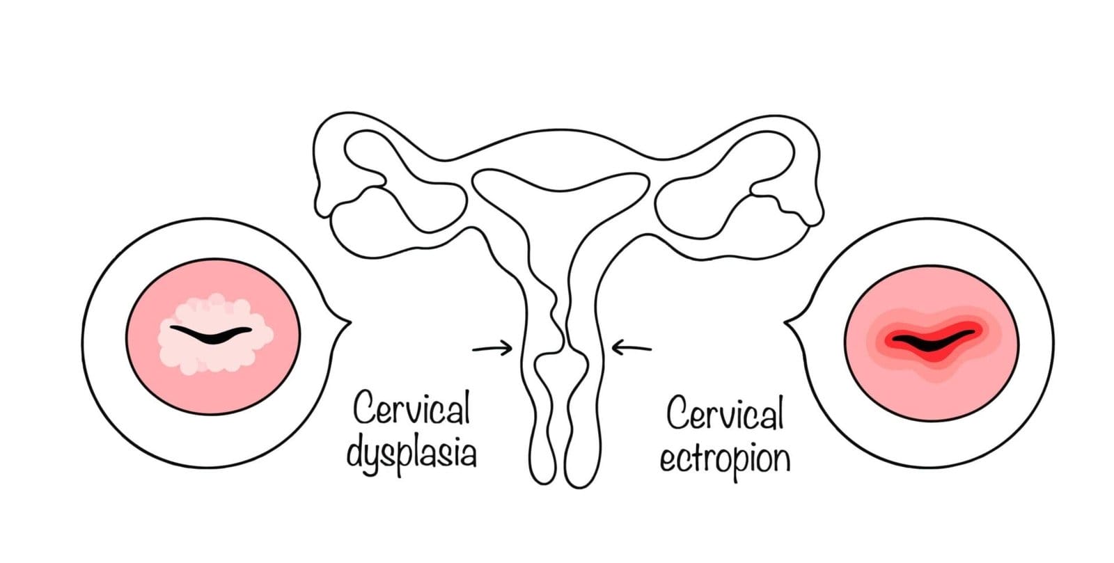 Cervicaldysplasia