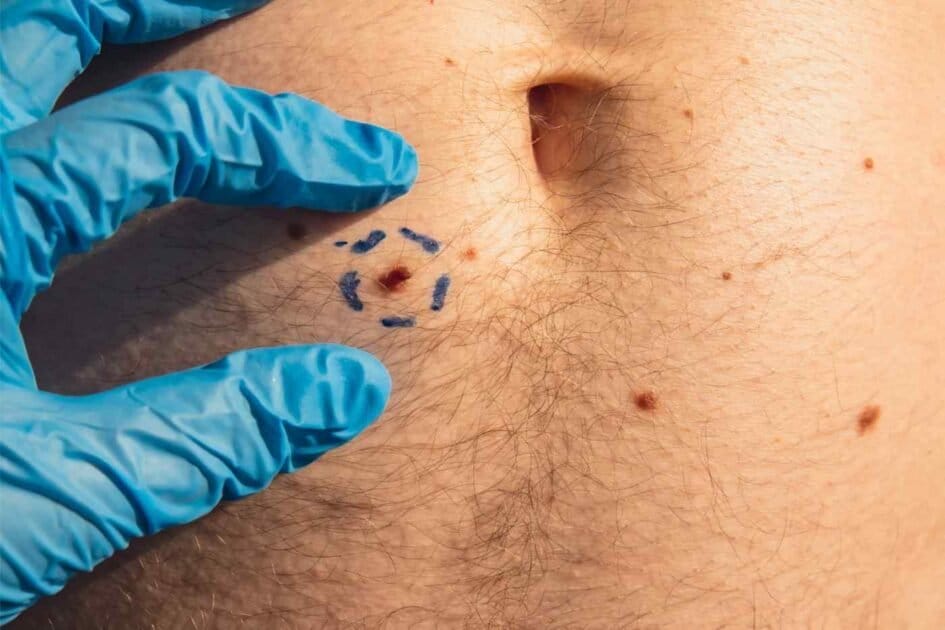 picture of a melanoma on the belly