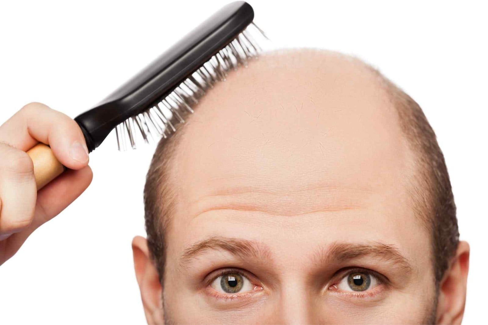 what causes hairloss in men?