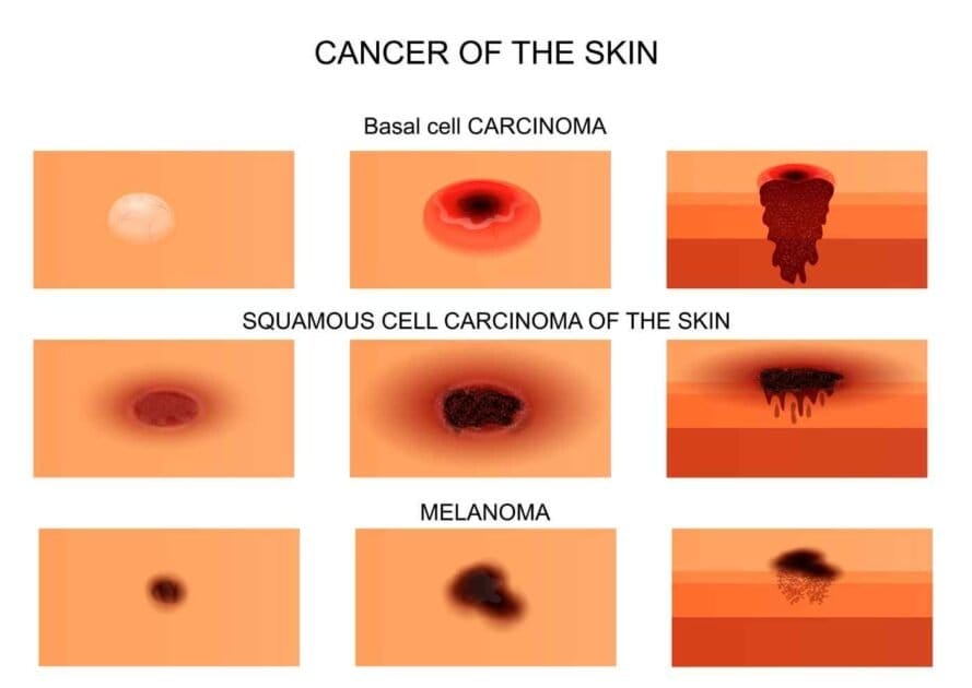 diagram showing various pictures of cancer in the skin